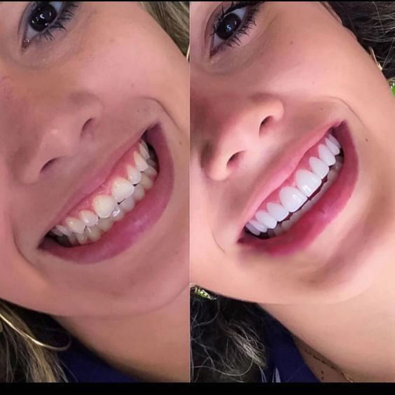 lentes de contato dental antes e depois